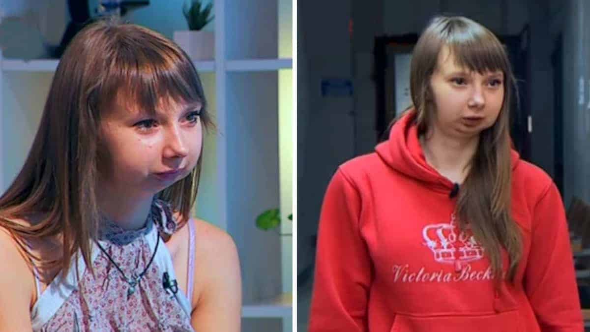 La ragazza a cui i medici hanno ricostruito la parte inferiore del viso: una storia unica e toccante