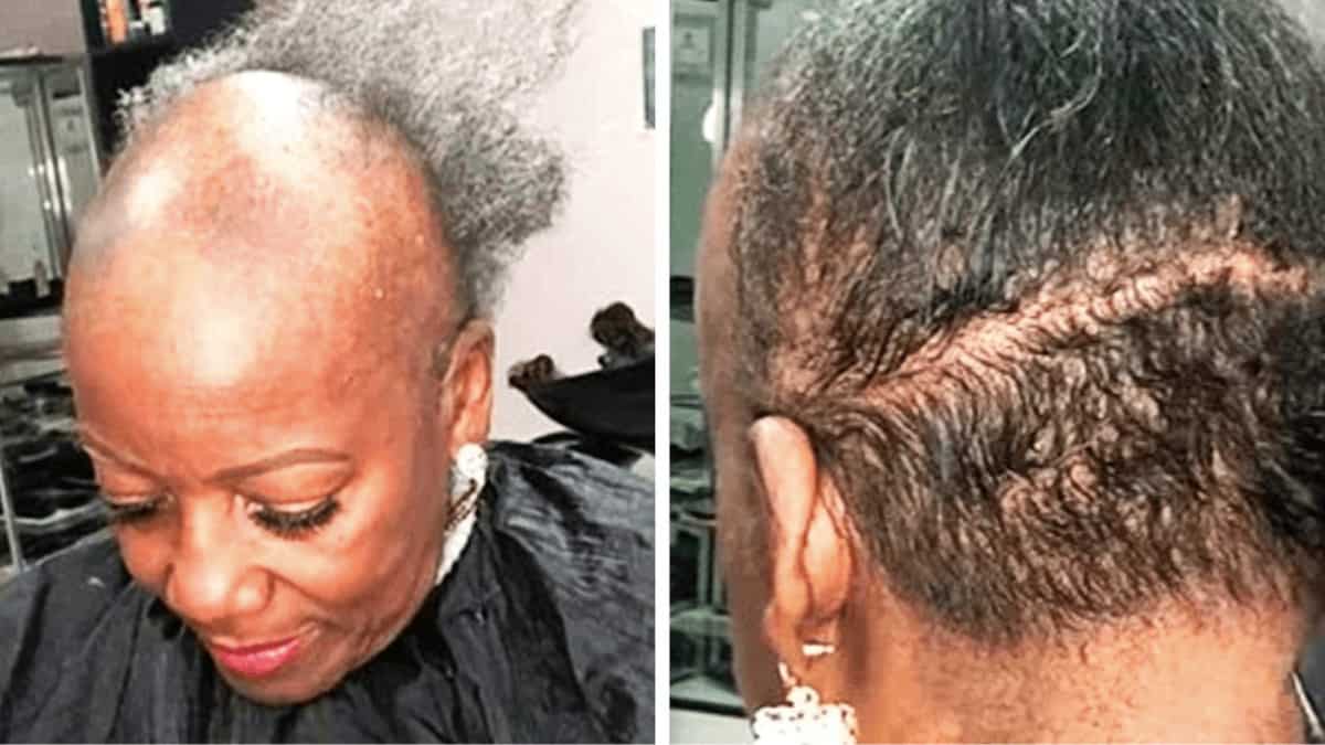 A causa della perdita di capelli, la donna si vergognava di uscire: così un parrucchiere ha risolto il problema